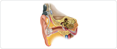 Image of an Eelectro-acoustic stimulation implant