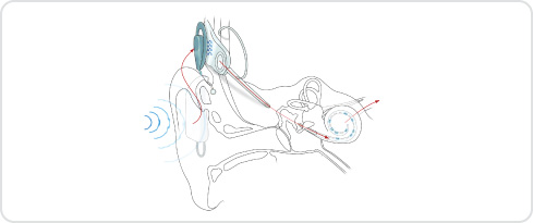 Image of the internal electrodes of an implant