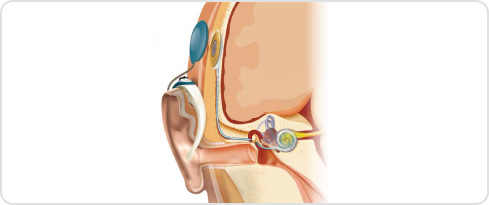 Image of the internal electronics and magnet of an implant