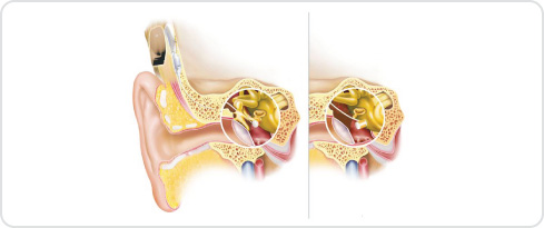 Image of a middle ear implant