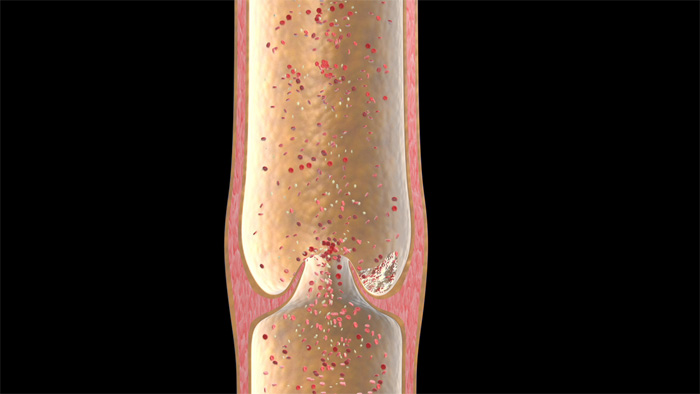 Still from "A guide to hospital-acquired deep vein thrombosis and pulmonary embolism"