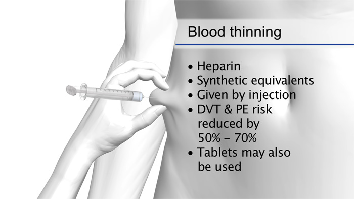 Still from "A guide to hospital-acquired deep vein thrombosis and pulmonary embolism"