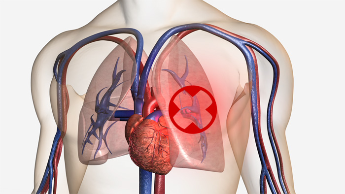 Still from "A guide to hospital-acquired deep vein thrombosis and pulmonary embolism"