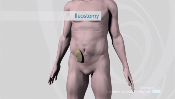 Still from the stoma care video