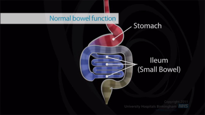 Still from the stoma care video